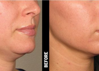 Ulthera for Acne Scarring: A Promising New Treatment Option