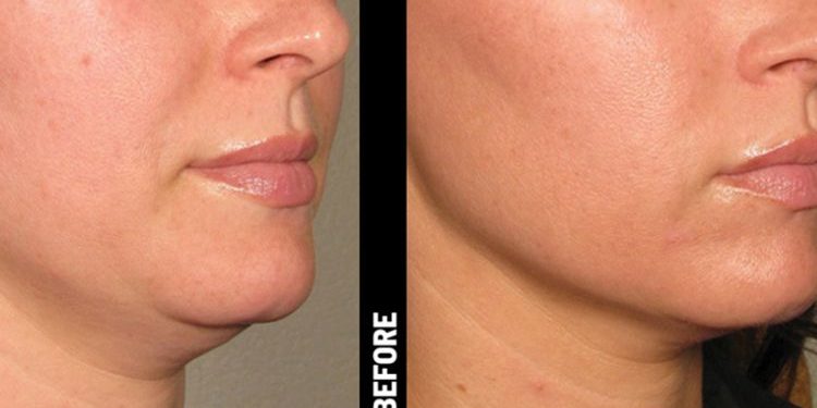 Ulthera for Acne Scarring: A Promising New Treatment Option
