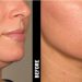 Ulthera for Acne Scarring: A Promising New Treatment Option